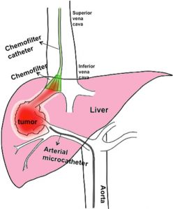 chemofilter