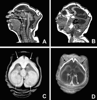 microcephaly