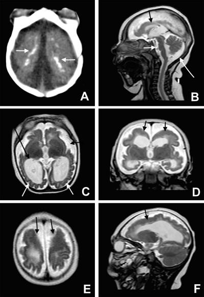 microcephaly 