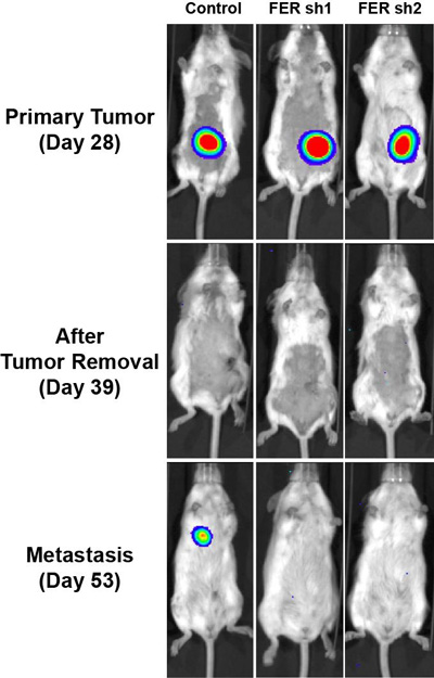 ovarian cancer