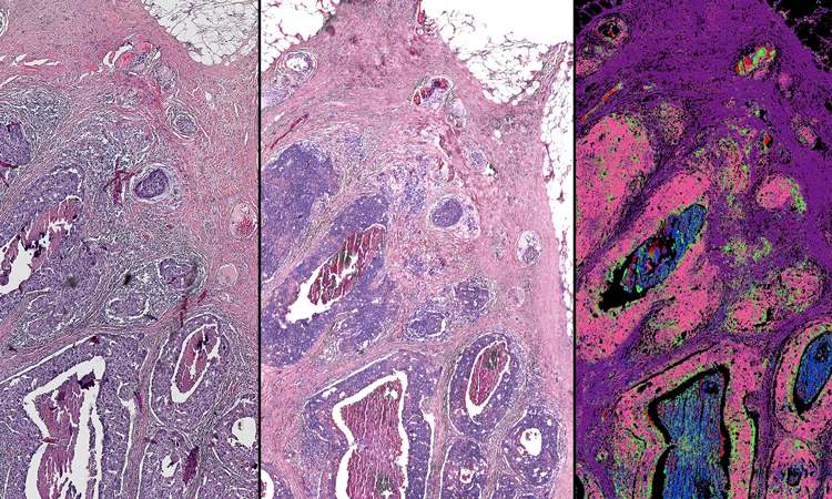 Stainless imaging of cancer