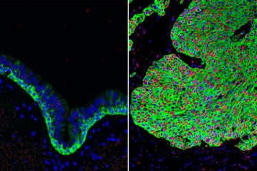 Normal airway tissue, left and lung cancer tissue, right