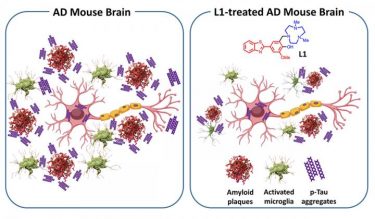 Alzheimer's image