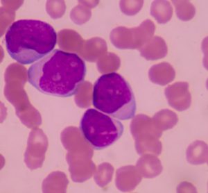 acute myeloid leukaemia