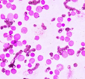 Acute myeloid leukaemia
