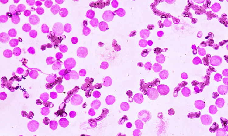 Acute myeloid leukaemia