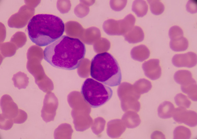 acute myeloid leukaemia