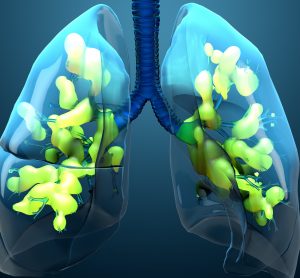 computer image of lungs in blue effected by acute respiratory distress syndrome (ARDS)