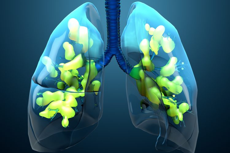 computer image of lungs in blue effected by acute respiratory distress syndrome (ARDS)