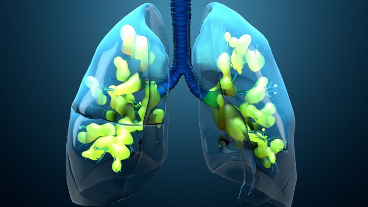 computer image of lungs in blue effected by acute respiratory distress syndrome (ARDS)