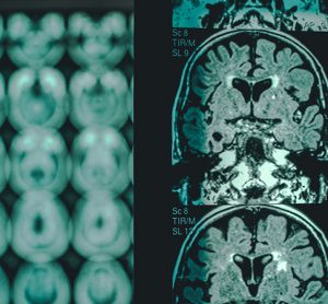 Neurodegeneration