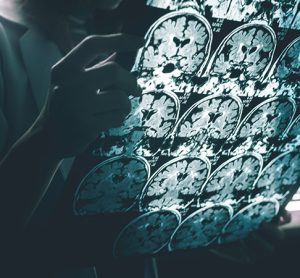 Someone hollding brain scans showing alzheimer's disease on MRI