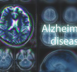 Alzheimer's disease