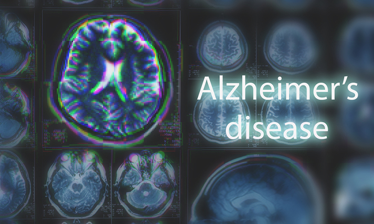 Alzheimer's disease