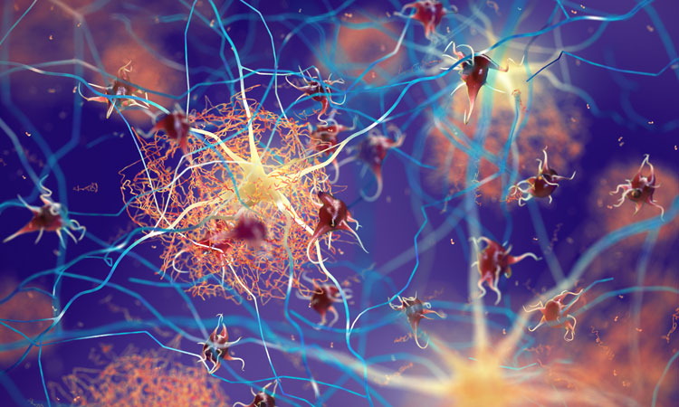 Alzheimer's neurons image