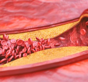 Peptides to treat atherosclerosis