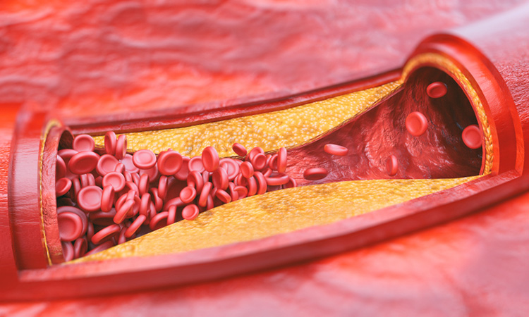 Peptides to treat atherosclerosis