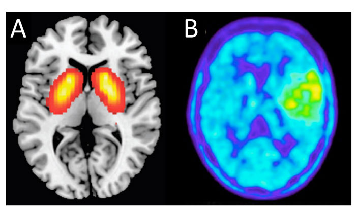 Figure 2 Bailey screening