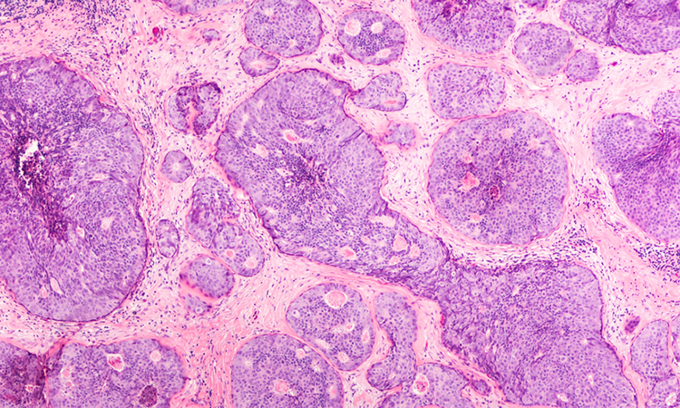 Breast cancer tissue