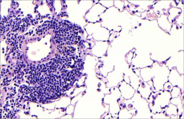 Lung section from mice exposed to chronic cigarette smoke for six months highlighting the developing follicles, seen here as dense tightly packed inflammatory cells (small purple/blue circles), and increased airspace enlargement from damaged alveolar structures both of which are characteristic pathological features of COPD in patients [Credit: Helmholtz Zentrum München]. 