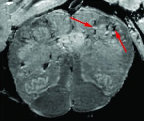 In an in-depth study, NIH researchers consistently found blood vessel damage in the brains of COVID-19 patients but no signs of SARS-CoV-2 infections. Here is a high-resolution scan of a patient's brain stem. Arrows point to light and dark spots that are indicative of blood vessel damage observed in the study [Credit: Courtesy of NIH/NINDS].