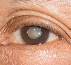 Cataract in eye