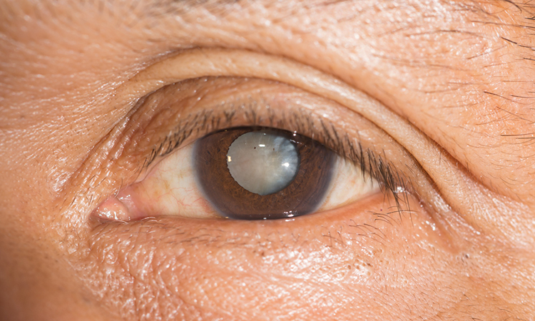 Cataract in eye