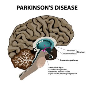 Webinar: in vitro phenotypic assays for Parkinson’s disease