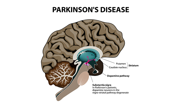 Webinar: in vitro phenotypic assays for Parkinson’s disease