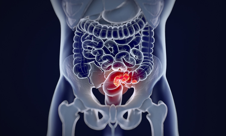 Colorectal cancer