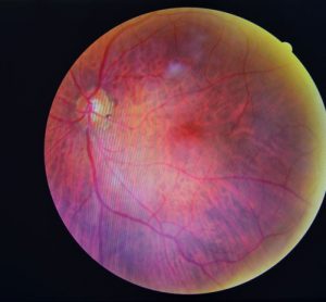 Researchers develop new tools in the fight against diabetic blindness