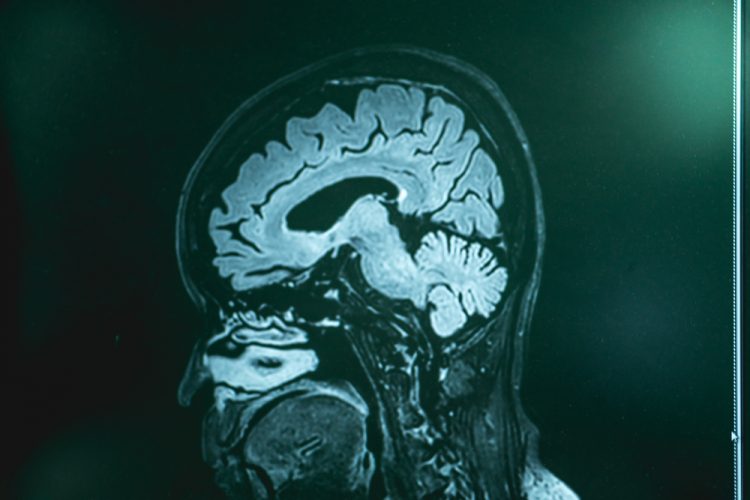 Frontotemporal dementia MRI