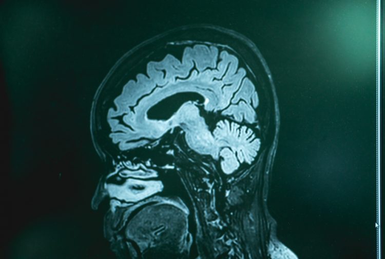 Frontotemporal dementia MRI