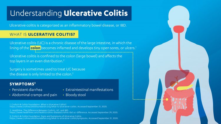 Targeting disease pathways to treat ulcerative colitis