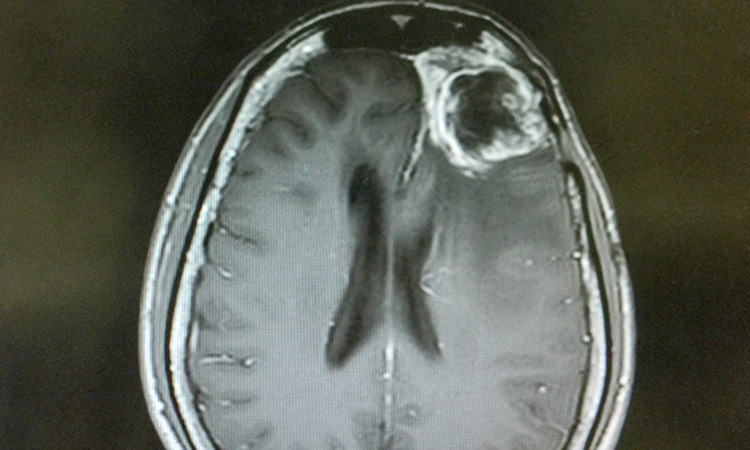 Glioblastoma