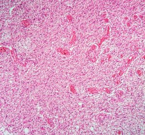 Drug combination to treat glioma