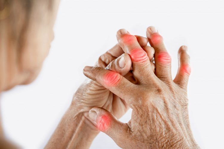 Woman holding her swollen finger joints - idea of gout arthritis