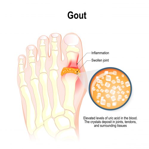 What cuases gout diagram - bones of the feet with a large yellow mass in big toe joint with a cutaway describing how uric acid crystals cause bone degradation and sewlling in gout