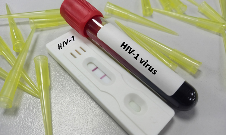 Test kit with blood sample for HIV-1 test, HIV screening test.