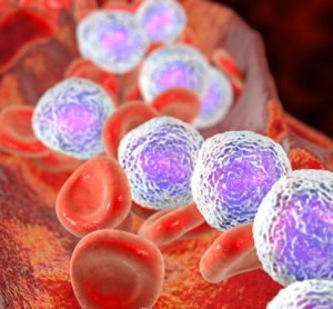Acute myeloid leukaemia