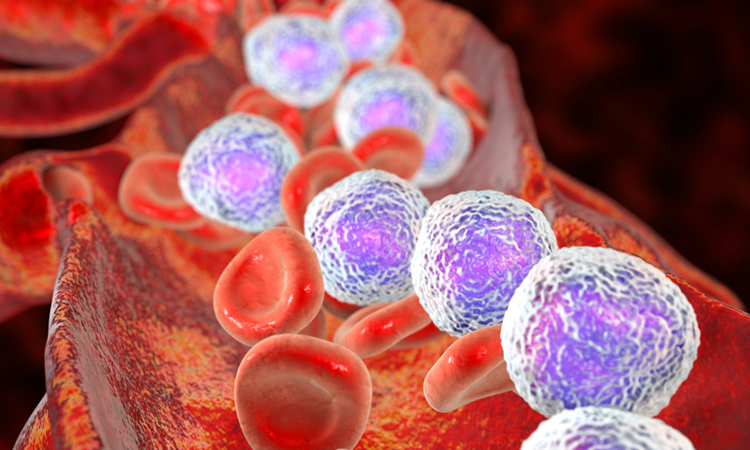 Acute myeloid leukaemia