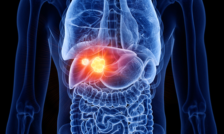 Liver cancer