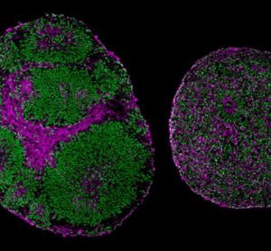 brain organoids derived from a patient with Pitt-Hopkins Syndrome (right) and from a control (left). Brain organoid on the right is significantly bigger than on the left
