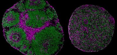 brain organoids derived from a patient with Pitt-Hopkins Syndrome (right) and from a control (left). Brain organoid on the right is significantly bigger than on the left