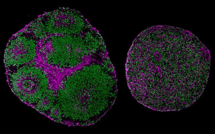 brain organoids derived from a patient with Pitt-Hopkins Syndrome (right) and from a control (left). Brain organoid on the right is significantly bigger than on the left