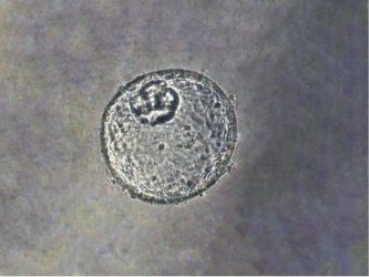 Image of human gastroesophageal junction-derived organoid, modified by dual-knockout of key tumor suppressor genes (TP53/CDKN2A) using CRISPR/Cas9 gene editing technology, which caused cells to become more cancerous.