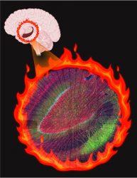 Image showing altered cells that create a "fire" in epilepsy patients