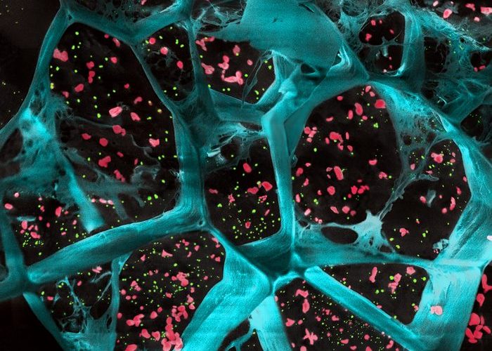 A high-magnification of the hydrogel (in blue) encapsulating T cell-activating platelets (in red) and nanoparticles that release a drug to inhibit tumor-boosting cells (in green).