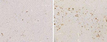 A decoy receptor causes multiple myeloma cell death (IMAGE): Compared with a control (left), treatment with a soluble BCMA decoy receptor (right) increases the number of dying cancer cells (brown) in a multiple myeloma tumor growing in mice.