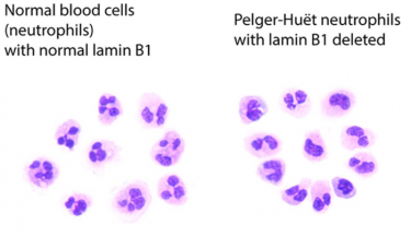 Image showing blood cells with abnormal nuclei